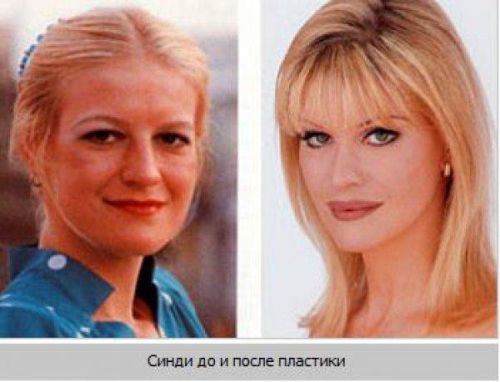 Валерия Лукьянова до операций и после с применением фотошопа