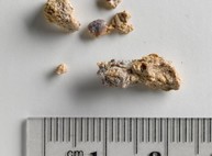Регулярный секс ускоряет выведение камней из почек