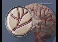 Говорящие на двух языках быстрее восстанавливаются после инсульта