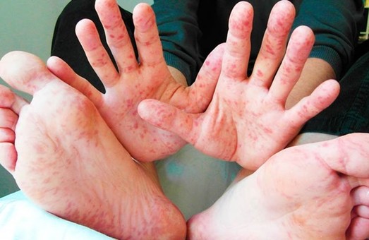 На Харьковщине - новые случаи заболевания корью