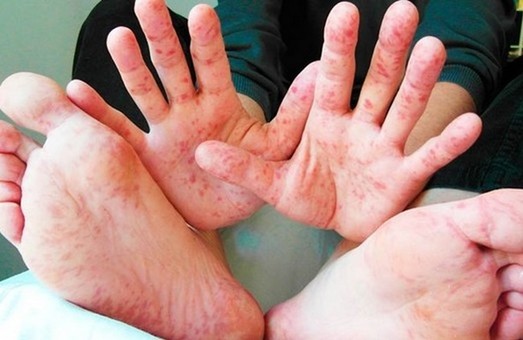 В Харькове - новые случаи заболевания корью